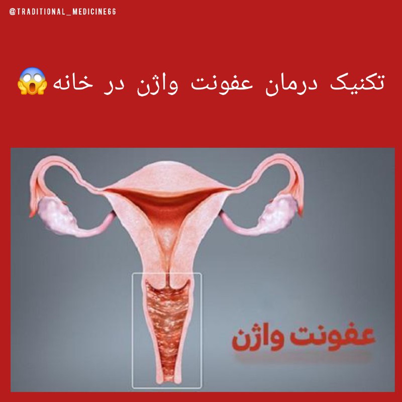 😍دنیای سلامتی و ترفند😍: چگونه عفونت واژن در خانه از بین ببریم👇 مشاهده تکنیک➡️