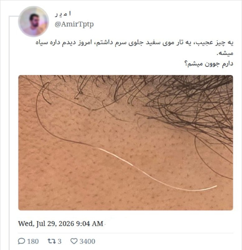 دخترا :: این اتفاق تو حجم زیادی برای من بعد از مهاجرت رخ داد که وقتی سرچ کردم متوجه شدم دلیلش اینه که اون موها بخاطر استرس سفید ش